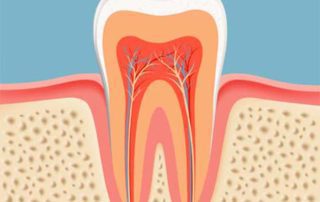 Root Canal Therapy in Lynnwood, WA