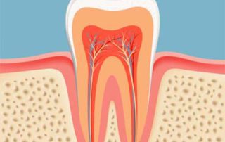 Root Canals in Lynwood, WA