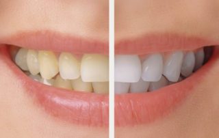 At Home Teeth Whitening Instructions in Lynwood, WA