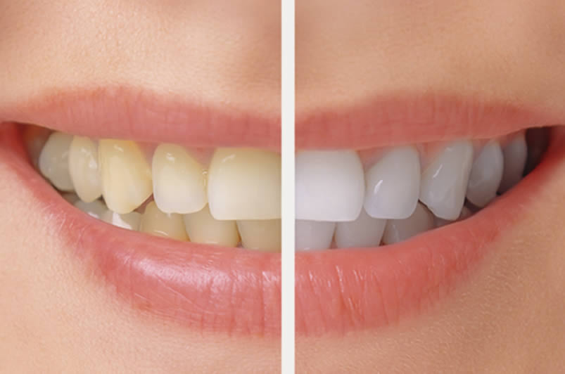 At Home Teeth Whitening Instructions in Lynwood, WA