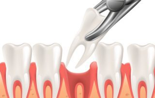 A graphic animation of a Tooth Extraction