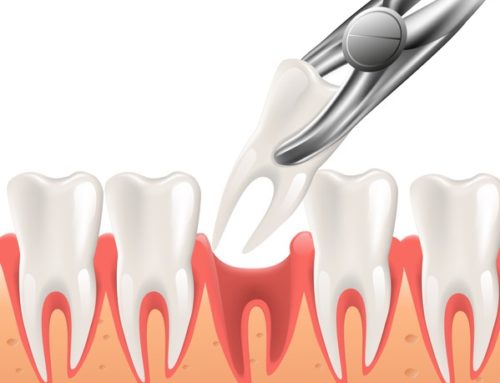 Home Care After A Tooth Extraction