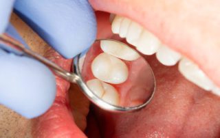 Home Care for Composite Fillings