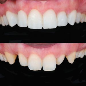 Smile Makeover in Lynnwood, WA