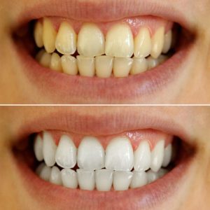 Teeth Whitening in Lynnwood, WA